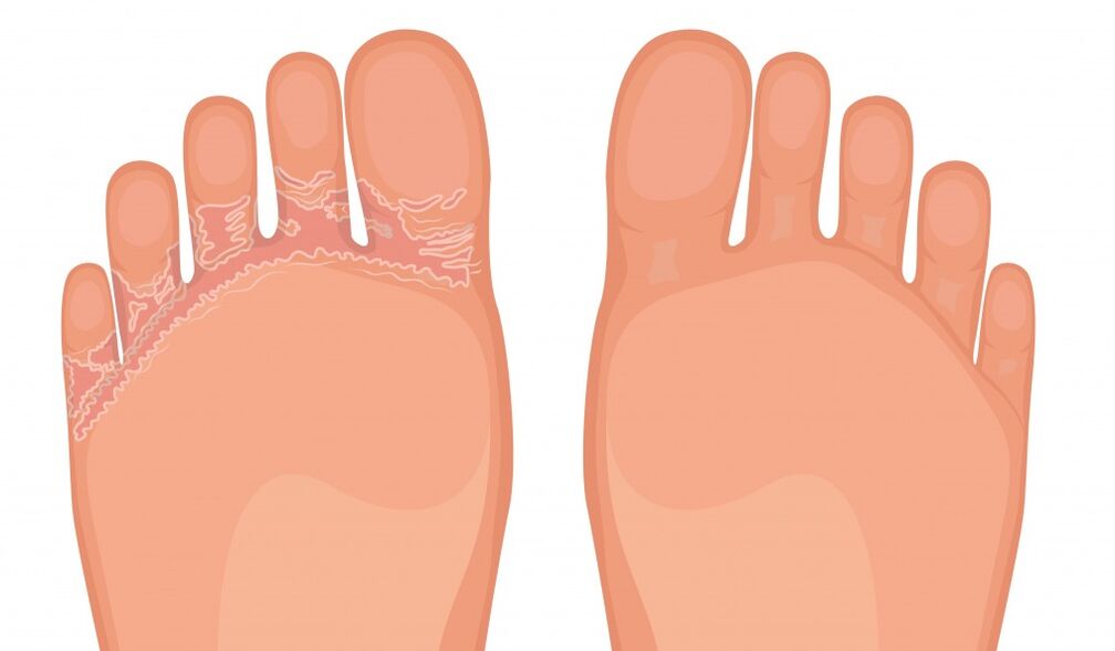 Fungent is effective against all types of foot fungus