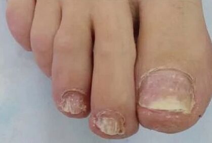 The nails were severely affected by the fungus. 