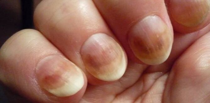 Infection with nail mycosis
