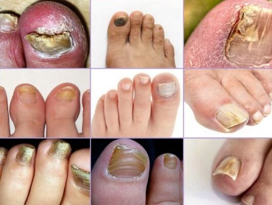 Nail damage to various types of fungi