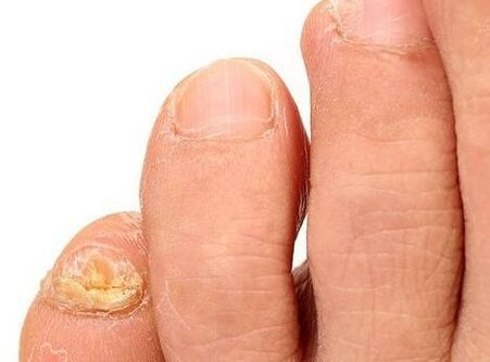 The fungus in the legs