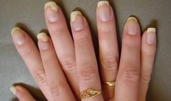 This is how the nail fungus is seen in the exacerbation stage