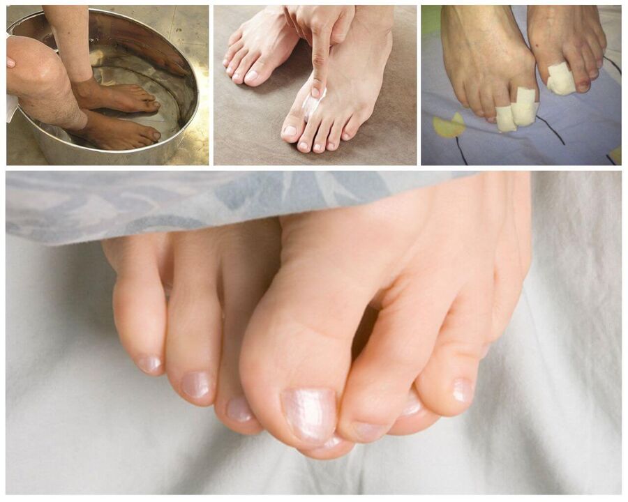 Fungal treatment