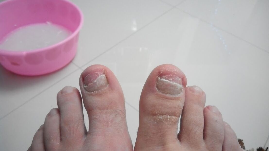 The fungus in the legs