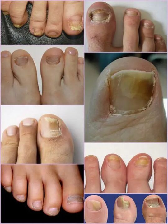Nail fungus varieties