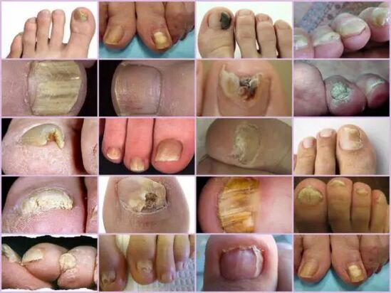 Onychomycosis of various location in the nail
