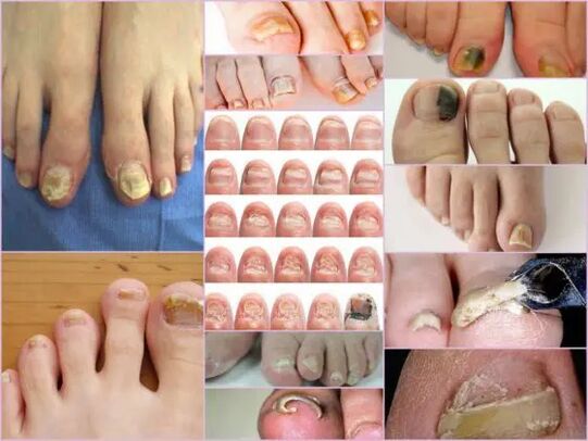 Varieties of onylomycosis