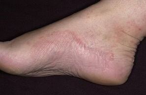 Funic damage to the foot