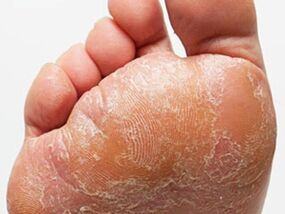 The fungus of the foot