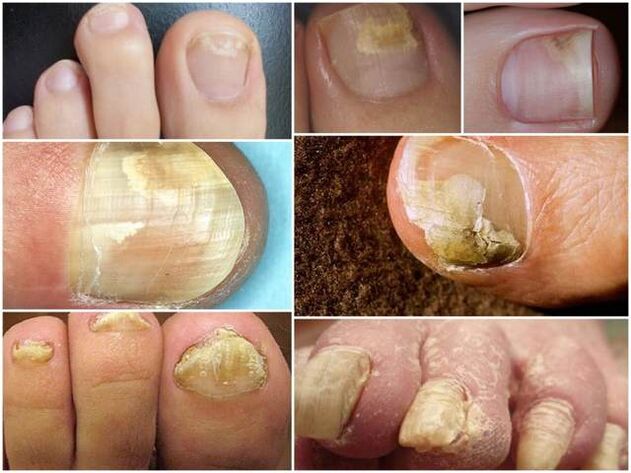 infection