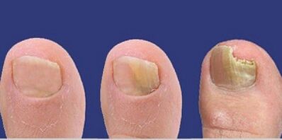 Stages of nail fungus development